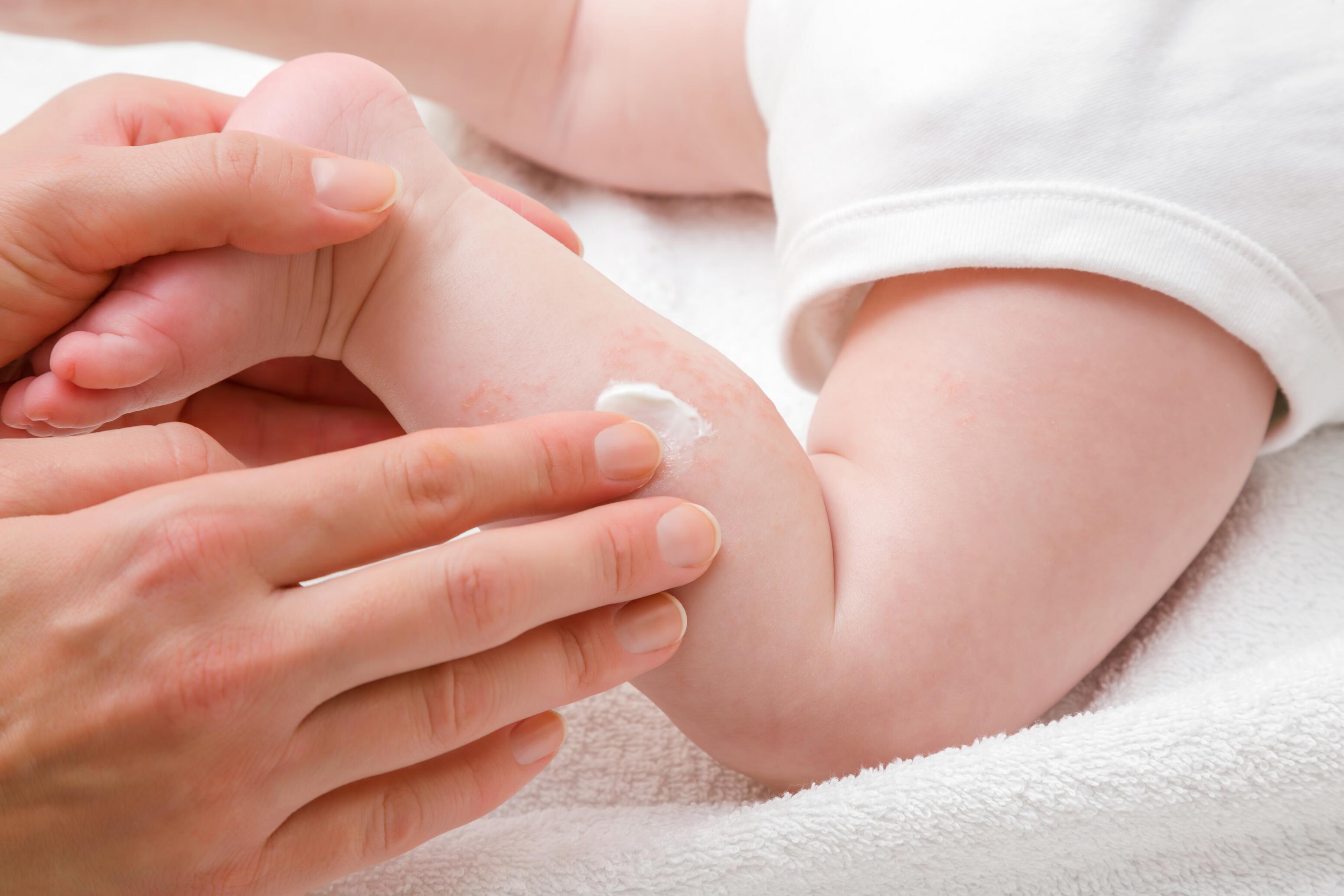 AD_EXOMEGA-CONTROL_ECZEMA_ANTI-SCRATCHING TIPS_01-2025